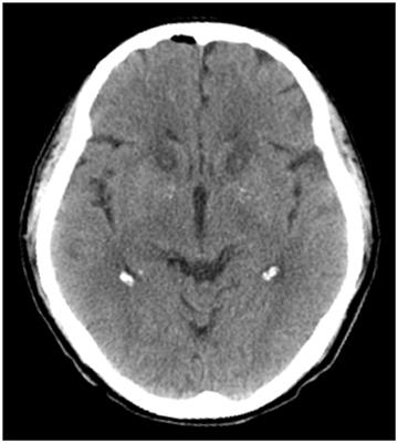 Bilateral Anterior Capsulotomy for the Treatment of Refractory Somatic Symptom Disorder: A Case Report